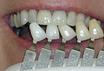 Teeth Whitening Color Match