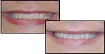 Immediate Teeth Whitening Results with Hamilton OH Dentist Dr. Fattahi