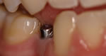 Dental Implants in Hamilton OH Dentist