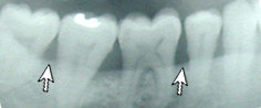 gum disease x-ray