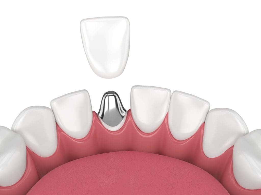 Hamilton Dental Group | Dental Crowns New