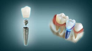 low_quality-mt3X5l4ZDq Exploded view of a dental implant: crown, abutment, and titanium implant separated from the jawbone with surrounding teeth on the right.