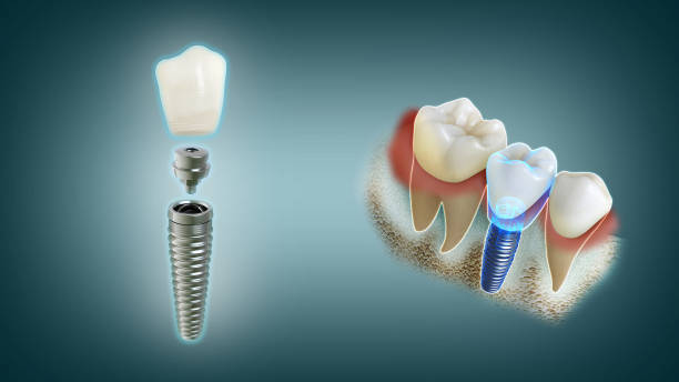 Exploded view of a dental implant: crown, abutment, and titanium implant separated from the jawbone with surrounding teeth on the right.