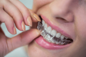 braces vs clear aligners