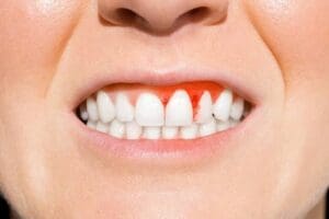 bleeding gums