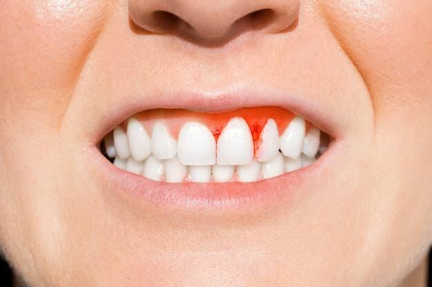 bleeding gums