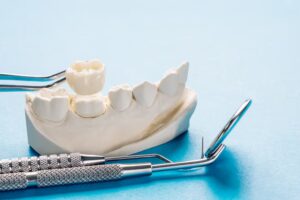 closeup-prosthodontics-prosthetic-single-teeth-crown-bridge-equipment-model-express-fix-restoration_60829-815 dental bridge problems