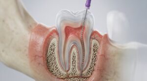 detailed-crosssection-tooth-undergoing-root-canal-treatment-with-specialized-dental-instrument_1194342-15123 root canal retreatment