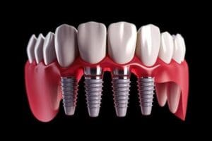 images (4) dental implant failure